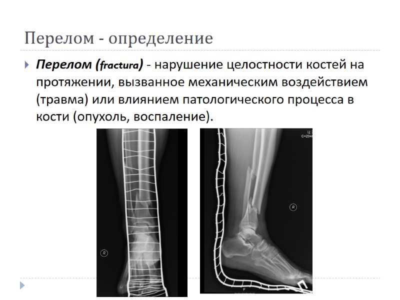 Перелом - определение  Перелом (fractura) - нарушение целостности костей на протяжении, вызванное механическим